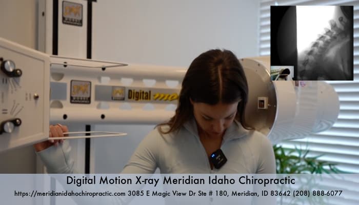 Image Car Accident Patient DIGITAL MOTION XRAY MERIDIAN IDAHO CHIROPRACTIC 