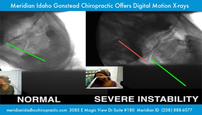 image with text Meridian Car Accident Chiropractor Dr. Todd Pickman Digital Motion X-rays