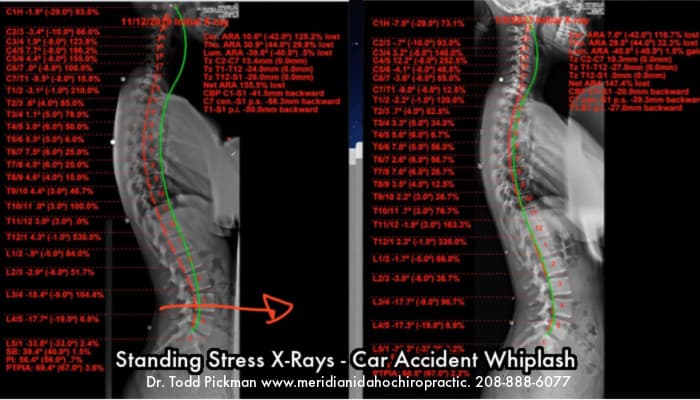 Image with text Standing Xray from Car Accident Chiropractor