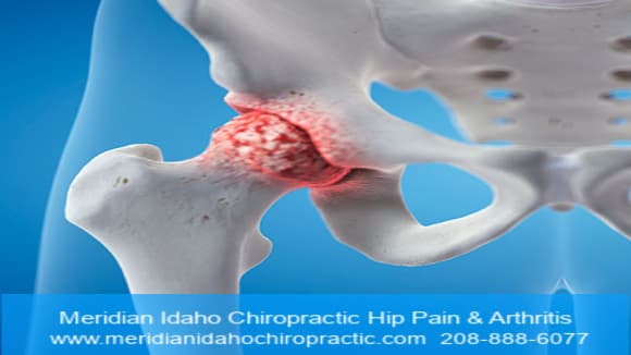 IMAGE WITH TEXT Meridian Idaho Chiropractic Hip Pain & Arthritis